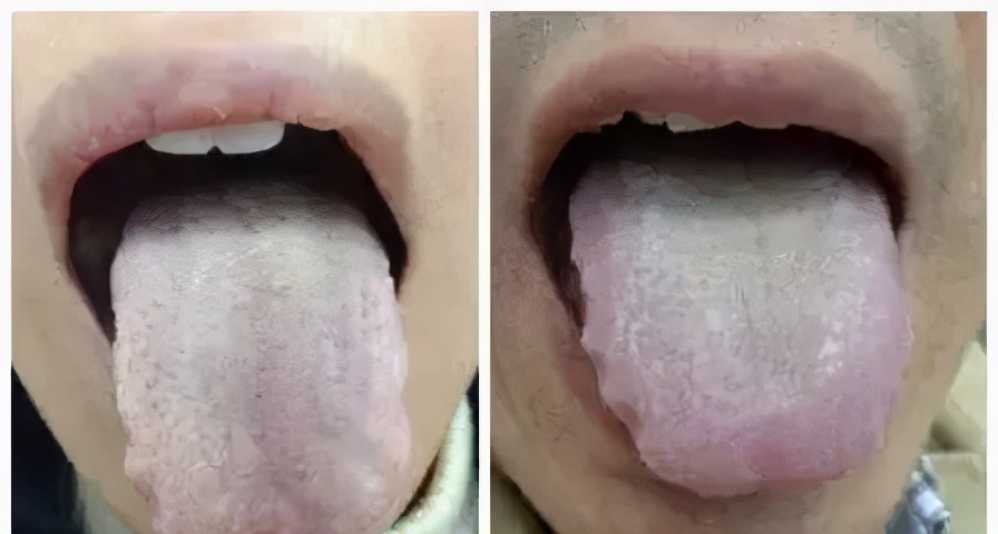 一招教你打通颈部富贵包,脖子上有筋包是经络不通吗