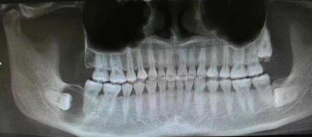 那些不拔智齿的人后来都怎么样了,那些该拔不拔的智齿最后都咋样了