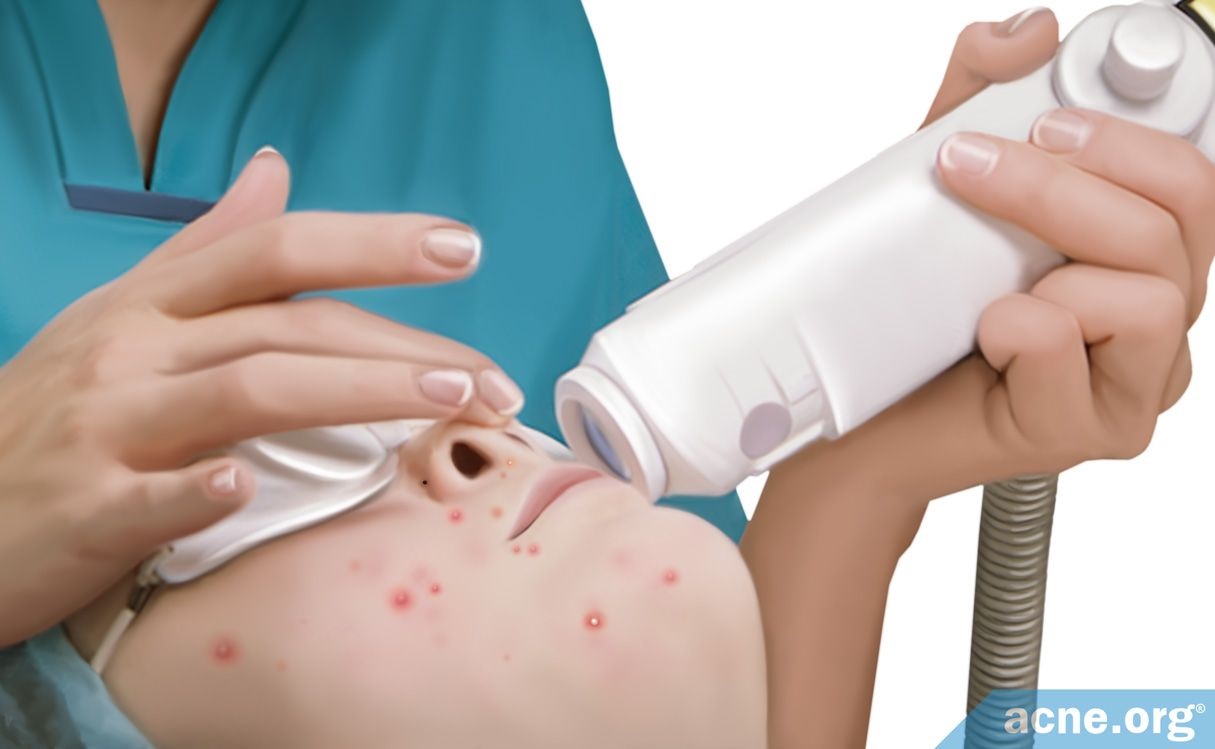 照光治疗痤疮有效果吗,激光能治疗痤疮吗