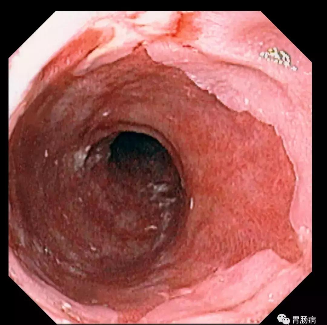 关于胃食管反流的两则医案,通俗易懂的讲胃食管反流病的表现