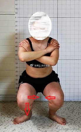 髋关节抬腿咯噔响移位,抬腿放下时髋关节弹响