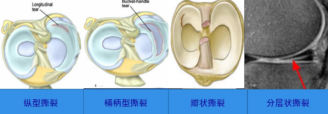 半月板损伤的症状及治疗方法,半月板损伤自测