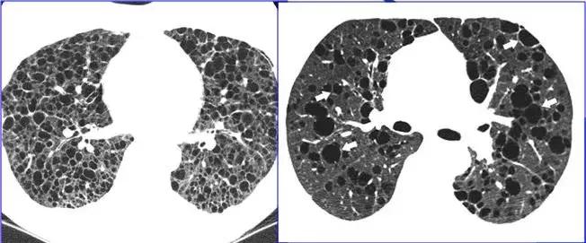 肺部ct十大征象,肺部ct正常图和异常图的区别