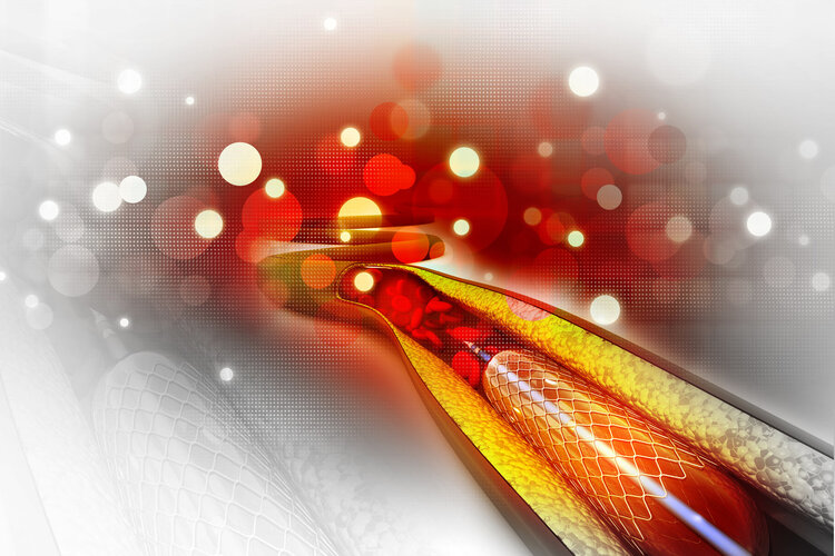 支架降价了手术后价格还是那么贵,支架降价了手术费用反而高了