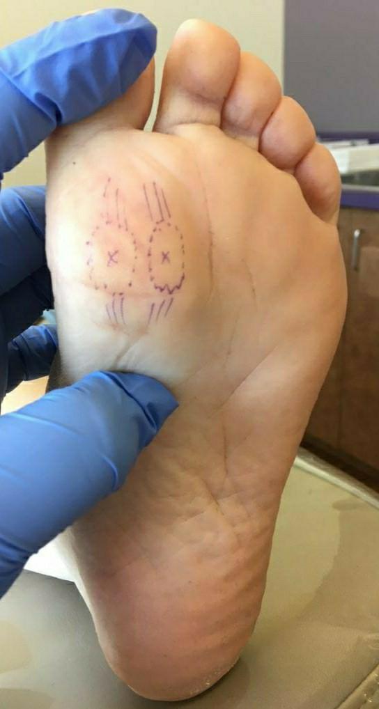 拇外翻大脚趾疼如何在家就能治,大脚拇指痛要警惕