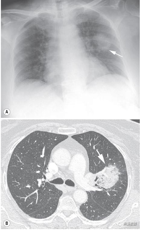 肺部感染并发症,老人新冠引起肺部并发症
