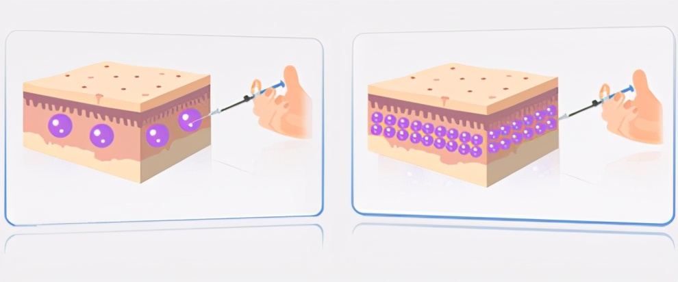 想做眼袋害怕翻眼,想做眼袋手术又怕失明