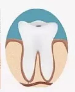 蛀牙补牙视频全过程,蛀牙不痛要做根管治疗吗