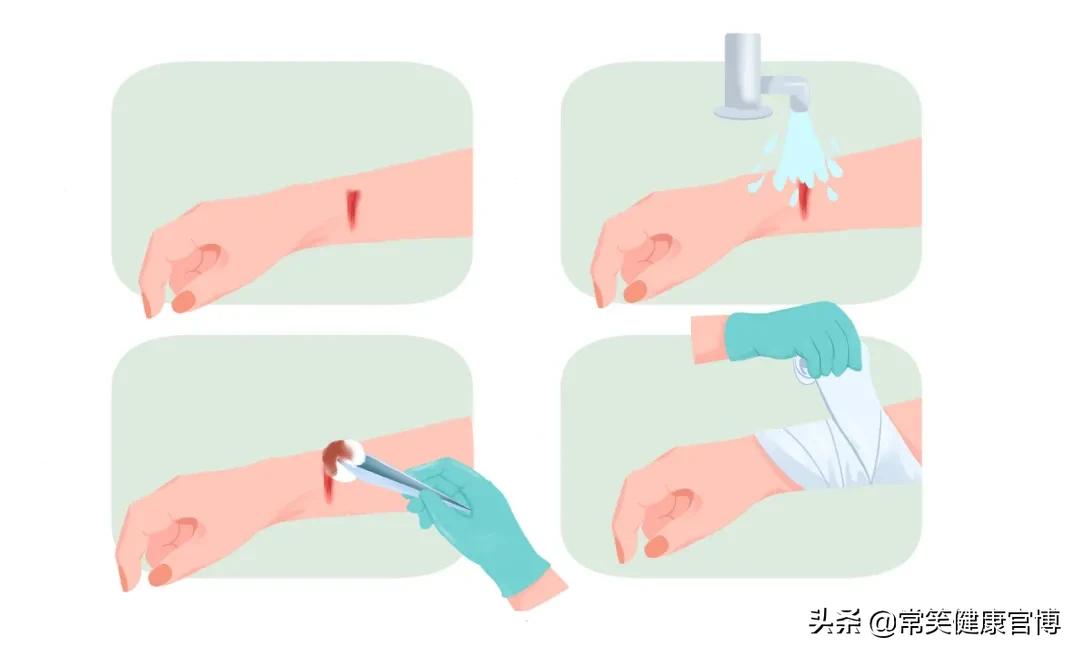 消毒水能驱走臭屁虫吗,口水可以杀菌消毒吗