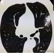 新型冠状病毒肺炎患者的肺,新型冠状病毒患者肺部体征