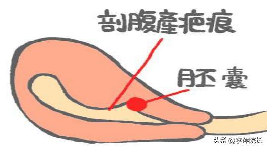 子宫疤痕憩室，宫腔积液有回流，怀孕机会比较低吗