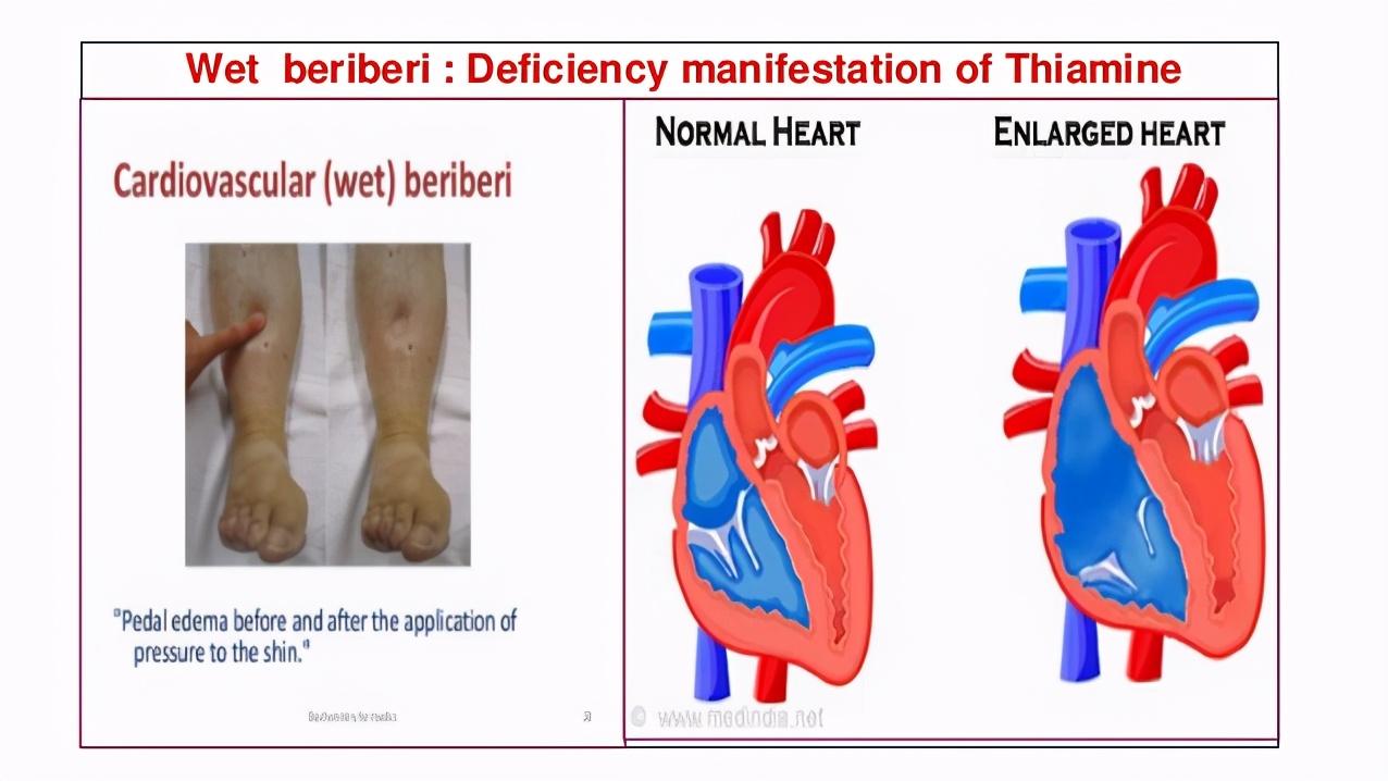 维生素b1缺乏症为啥叫脚气病,维生素B1缺乏引起的脚气病