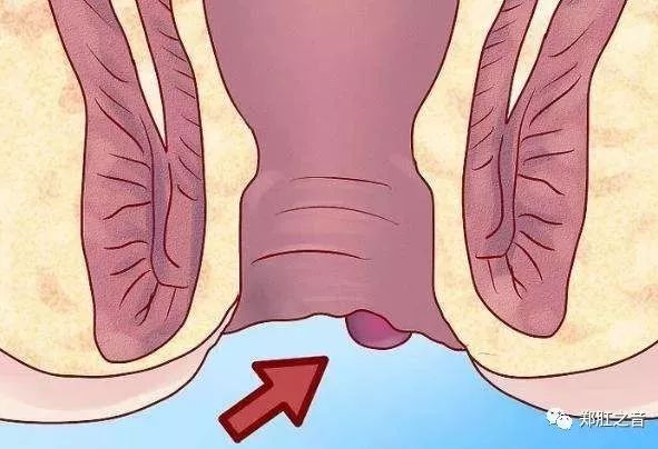 内外混合痔疮自己怎么分辨,怎么区分外痔疮类型