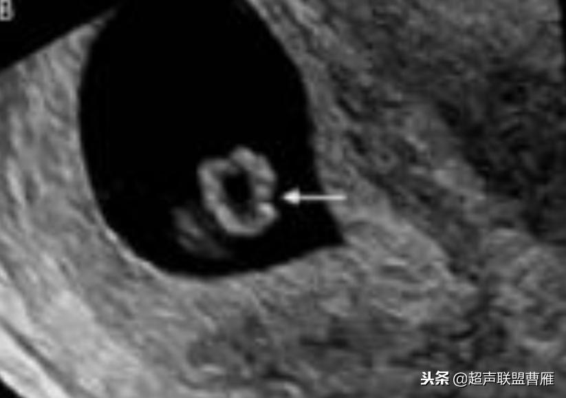 内见卵黄囊,卵黄囊肿瘤