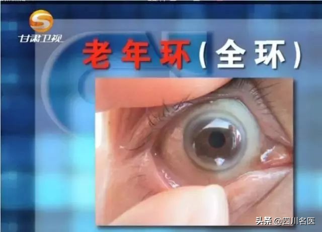 血脂高的人中脑梗心梗概率最大,血脂高8.5得心梗脑梗的几率有多少