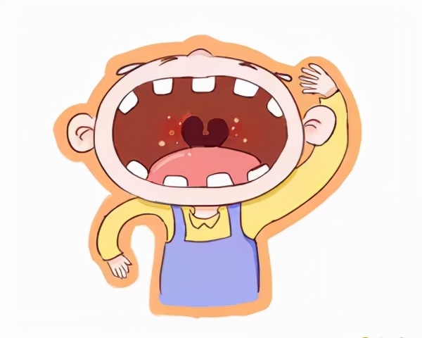 疱疹性咽峡炎中医辨证论治经方,疱疹性咽炎和疱疹性咽峡炎区别