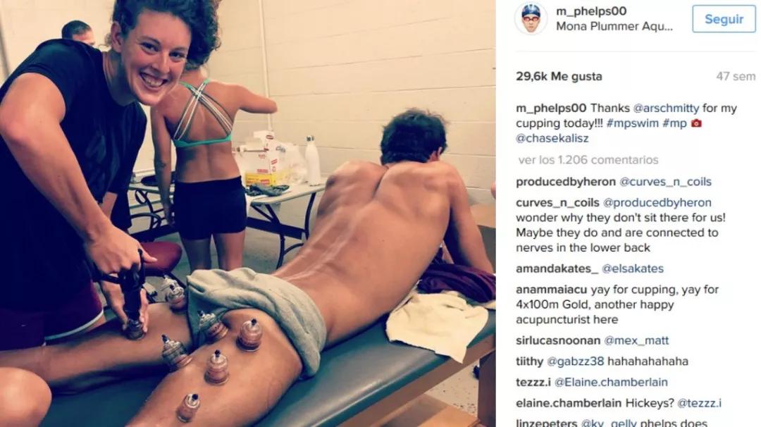 神秘“东方力量”再现奥运会！原来中医拔罐有这么多好处