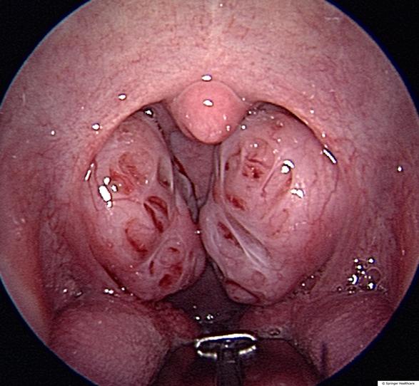 治疗扁桃体最好的方法是什么,讲解一下扁桃体的作用