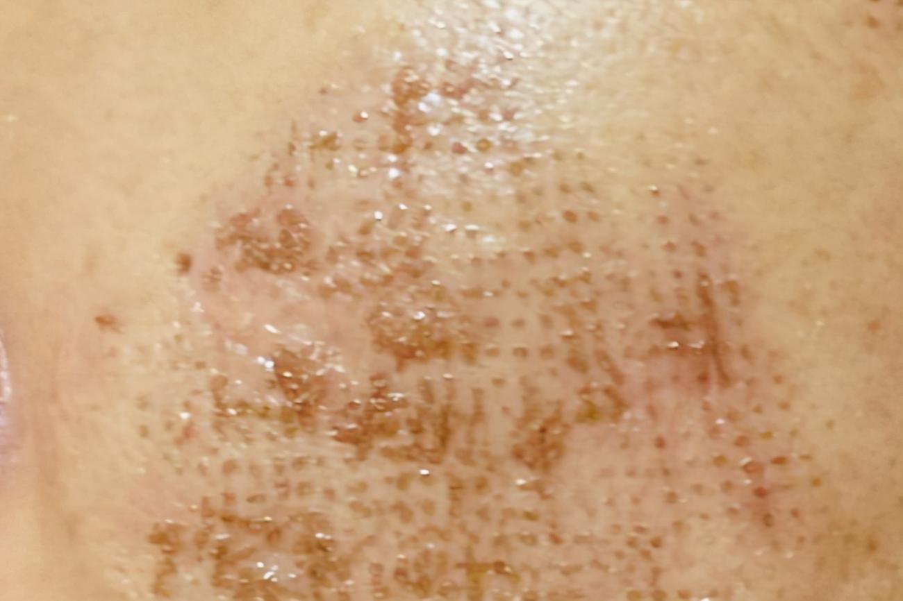 有创激光疤痕修复,脉冲激光治疗后怎么护理