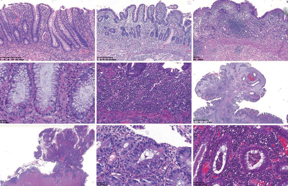 炎症性肠病的七种表现,炎症性肠病病理鉴别