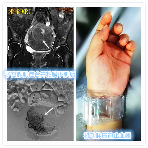 子宫腺肌症称为不死的癌症,子宫腺肌症是不死的癌症吗