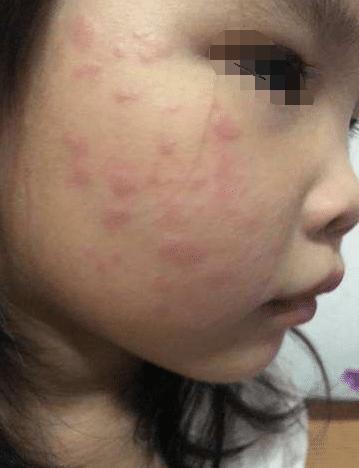 一岁宝宝老是揉脸怎么回事,婴儿脸上长痘痘一直用手搓