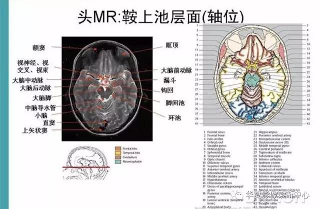 mra头颅解剖学详细讲解视频,常见的头颅mri图像