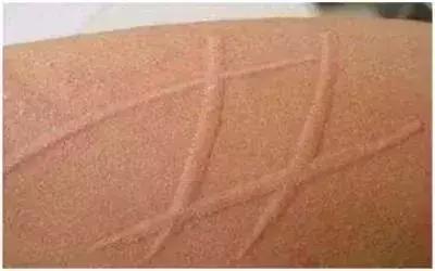 荨麻疹千万不要吃抗过敏的药,荨麻疹别不当回事谨慎伴随着肝炎