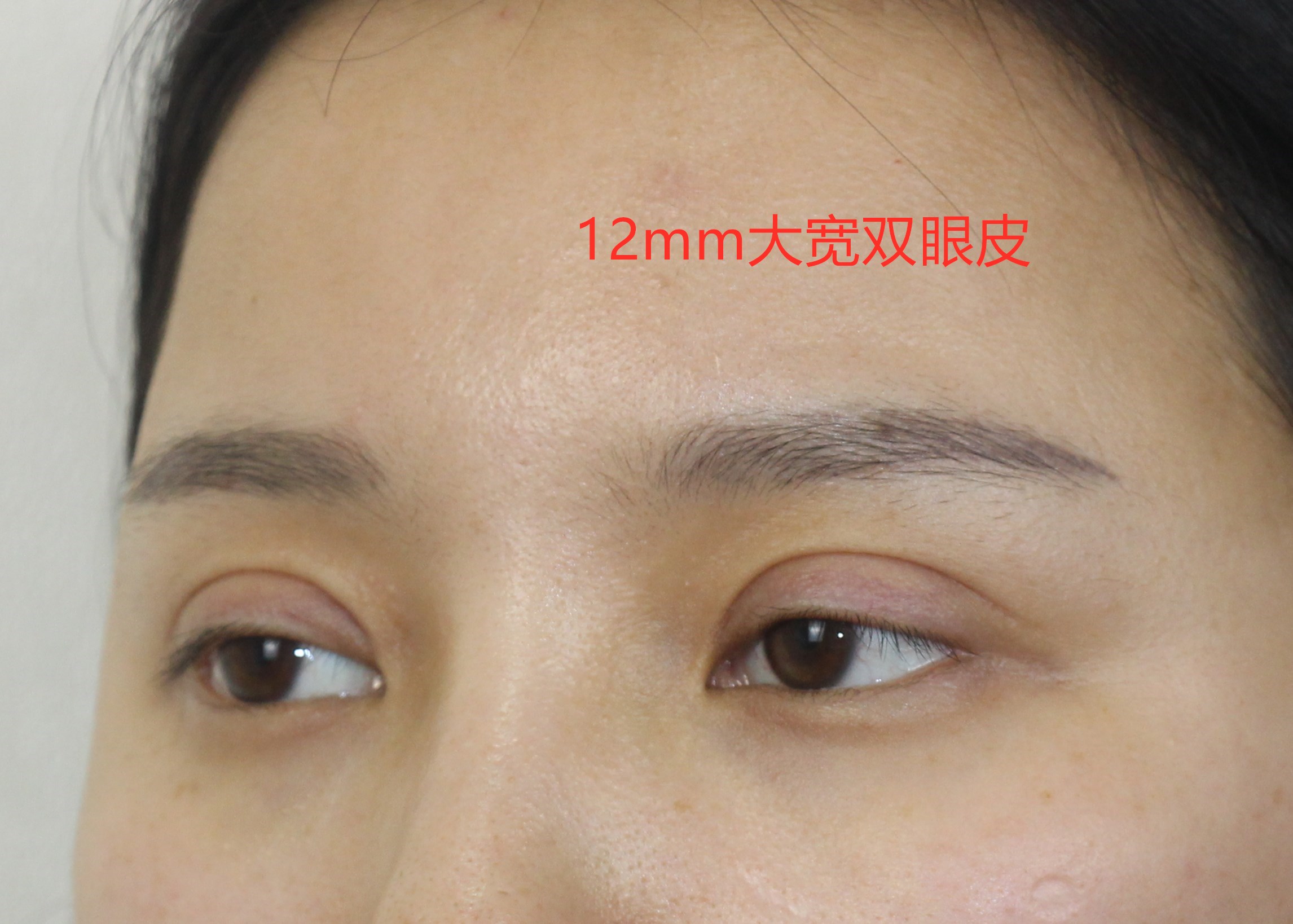 双眼皮术后出现肉条怎么办,双眼皮肉条感修复手术痛吗