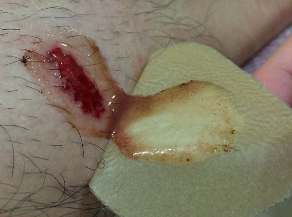 伤口感染细菌培养怎么操作,伤口被细菌感染了涂什么药