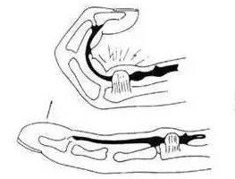 腱鞘囊肿怎样快速消除小妙招,腱鞘囊肿消除小妙招小视频