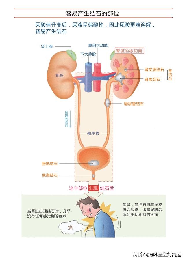 快速降尿酸治痛风的处方,痛风降尿酸中药靠谱吗