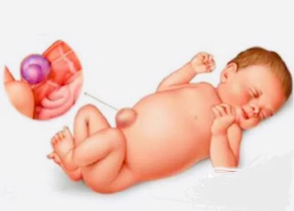 肚脐凸出来，十有八九是脐疝，大多会自愈