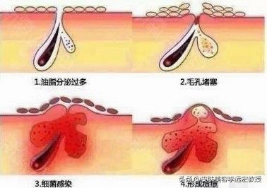 毛孔堵塞是病吗,皮肤暗沉毛孔堵塞怎么办
