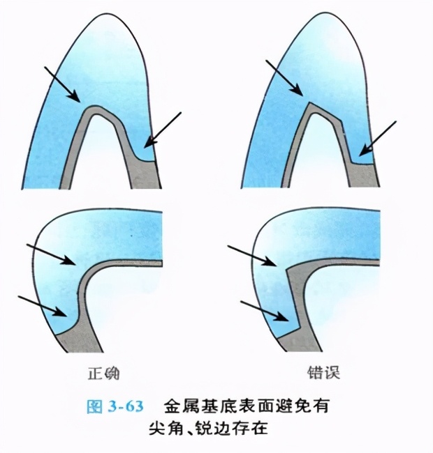 口腔金属冠与全瓷冠的区别,牙科医生讲义