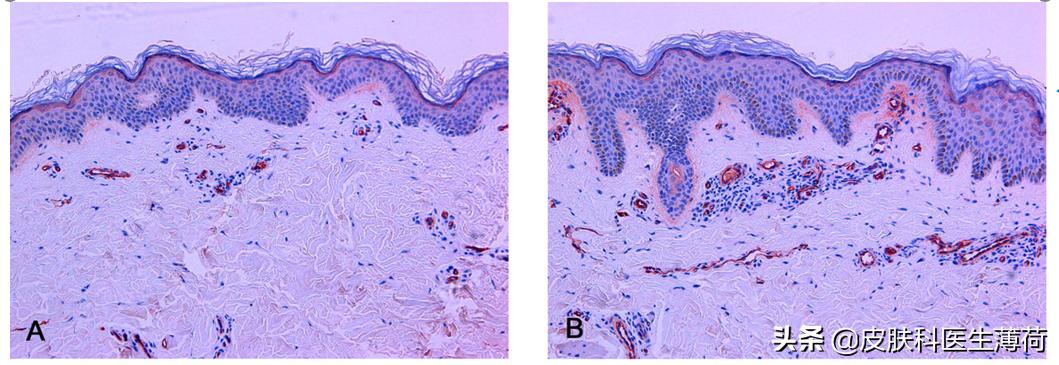 黄脸婆吃什么祛斑,告别黄脸婆自制纯中药祛斑面膜