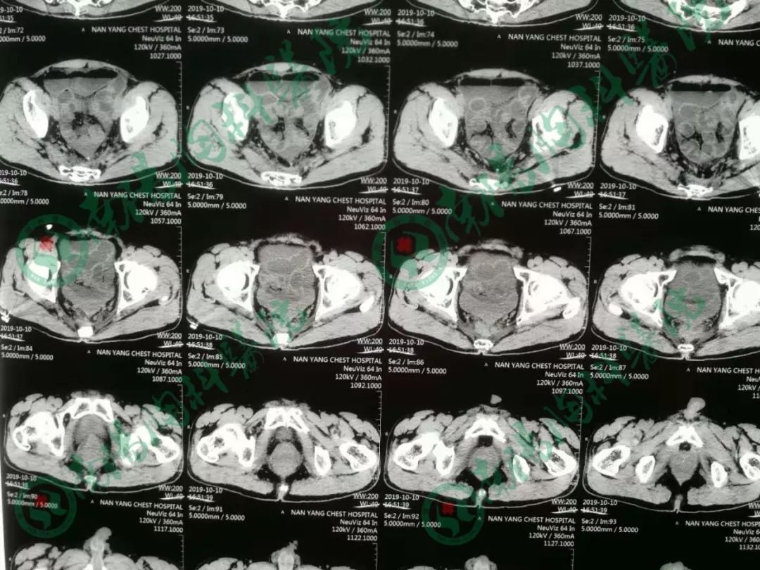 南阳市胸科医院,乌鲁木齐肿瘤医院治直肠癌