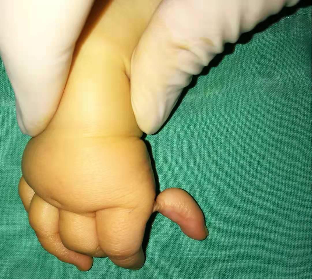 人如果没有肋骨会怎么样,人没有锁骨能活吗