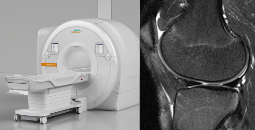 半月板损伤的症状及治疗方法,半月板损伤自测