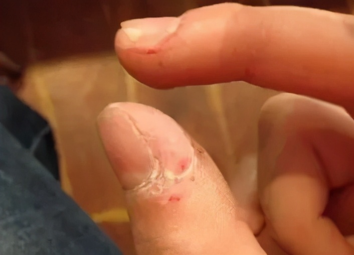 抠手、啃指甲停不下来，这些习惯要关注