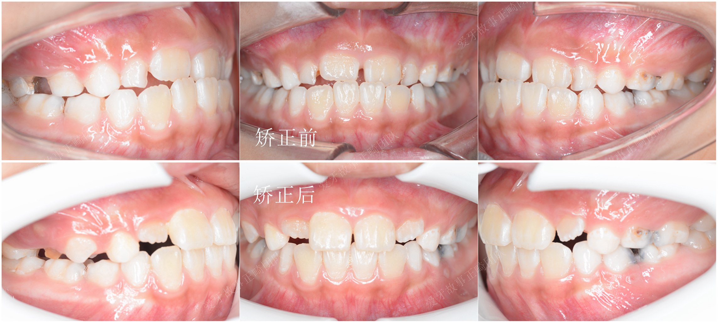 孩子换牙期反颌用治疗吗,如何矫正前牙反颌