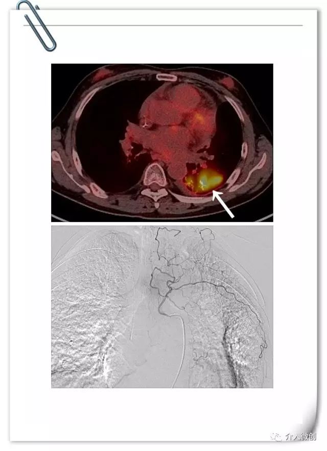 肺神经内分泌癌早期手术好吗,肺部神经内分泌肿瘤治疗