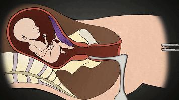 堕胎手术到底有多可怕,堕胎手术可怕的真相