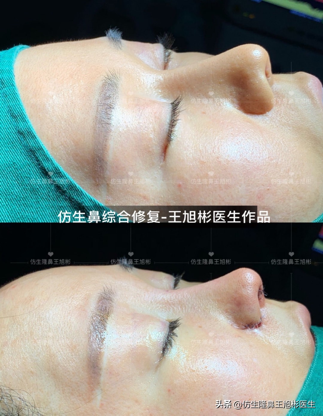 隆鼻的骨粉不取出有什么危害,骨粉隆鼻没有不适需要取出吗