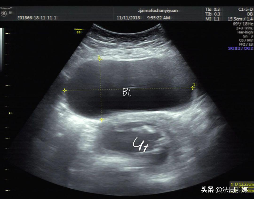 孕妇排尿困难怎么办最快最有效,孕妇小便难解是什么原因