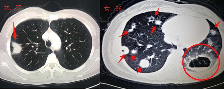 肺癌就像黑涩会，这3步重拳打出去，能抓住80%的肺癌团伙