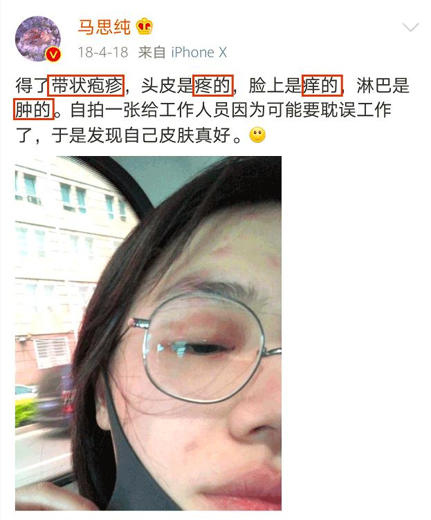 马思纯患带状疱疹,马思纯治病经历