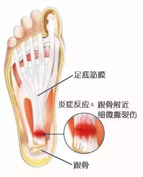 脚后跟一踩地就疼能治好吗,骨科医生告诉你足底痛的8个问题