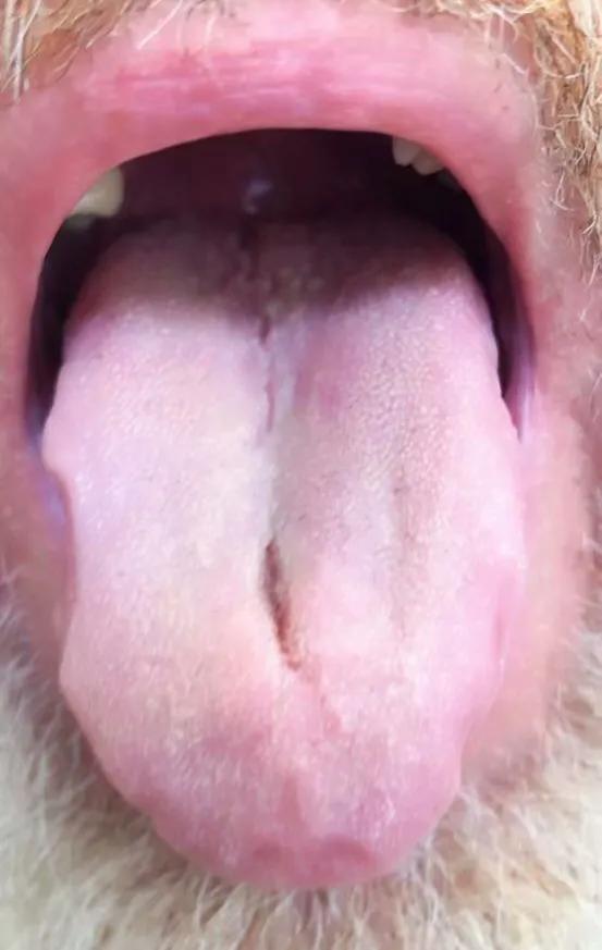 流口水针灸扎几个止涎穴,董氏奇穴治成人流口水