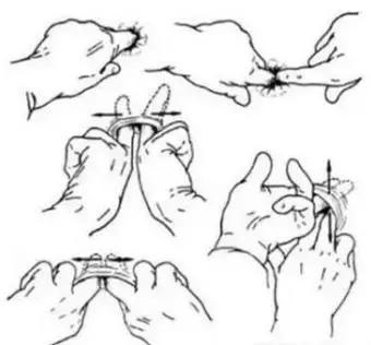 如何科学防治肛裂,肛裂预防